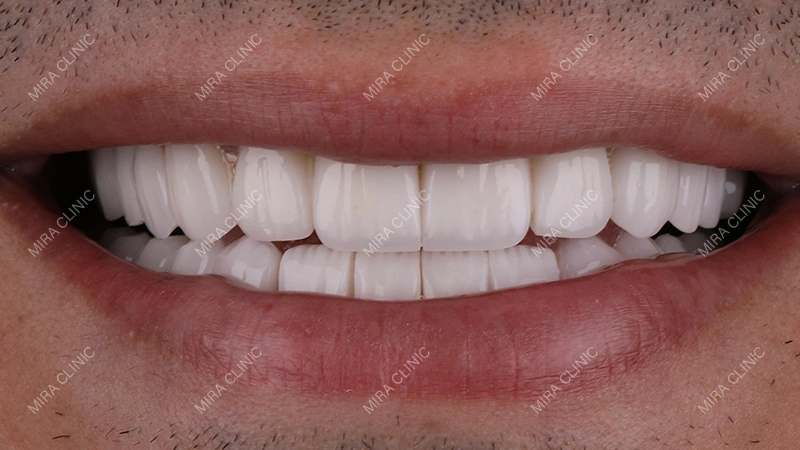 Hollywood Smile